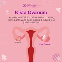 Gambar kista ovarium